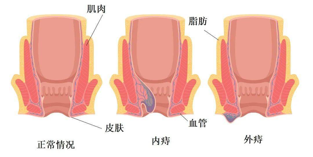 痔疮怎么形成的图片