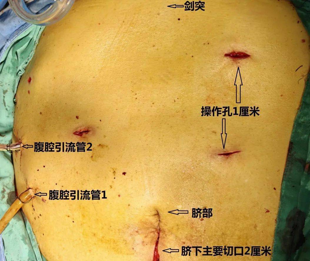 肝胆外科完成超高龄,超高难度腹腔镜下肝门胆管癌根治术