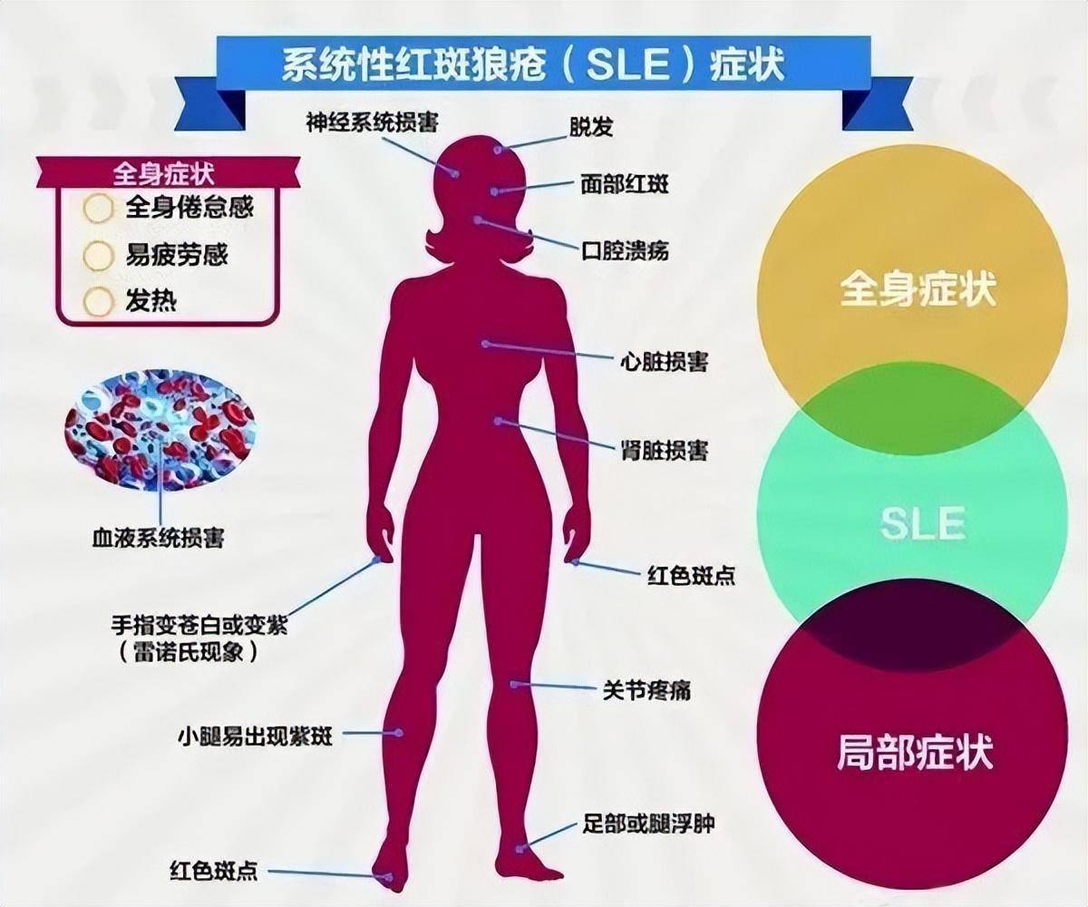 "不死癌症"系统性红斑狼疮到底有多可怕?_疾病_关节_症状