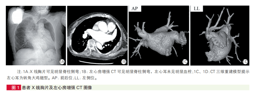 左心房增強ct示左心房未見充盈缺損徵象(圖1b),ct三維重建模型示左心