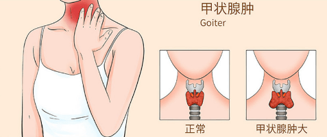 經過一系列檢查,觸診,結合b超提示