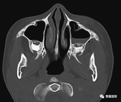 【急診】顴骨骨折,上頜骨骨折ct表現_fort_竇前壁_竇外