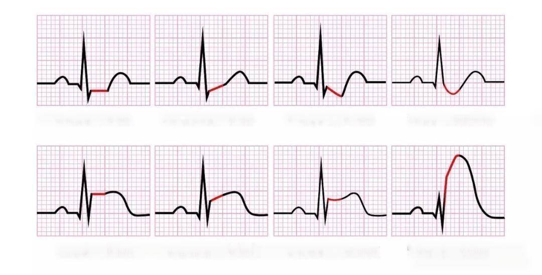 心电图报告说st