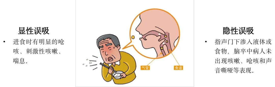 难咽之隐,小心误吸找上门