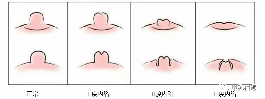 乳房酒窝是什么样子图片