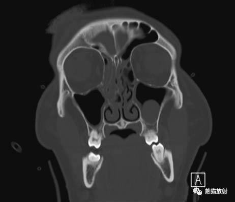 【急診】顴骨骨折,上頜骨骨折ct表現_fort_竇前壁_竇外