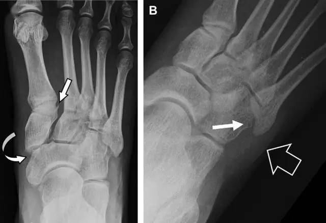 a 另一種類型的跗蹠關節損傷,中間楔骨向內側半脫位(弧形箭頭),從而使