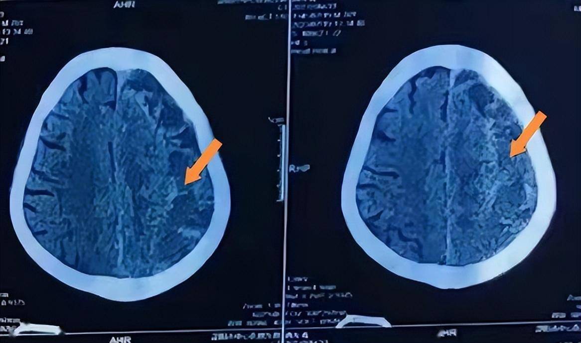 ct检查显示有新月形影子,结合唐大爷病史,确诊其为慢性硬膜下血肿