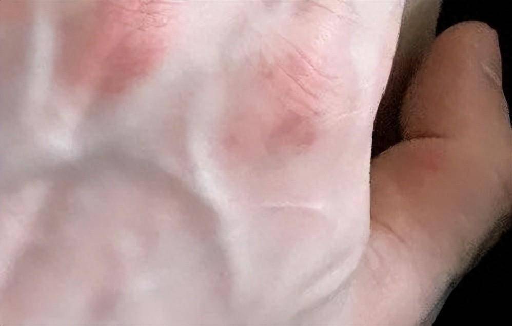 肚子上多了几条青筋,竟然查出肝硬化!