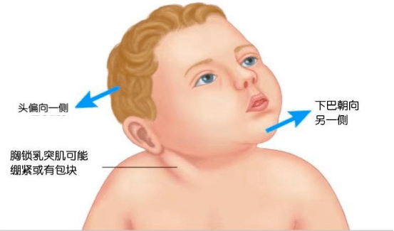 健康科普 三步推拿法治疗小儿肌性斜颈
