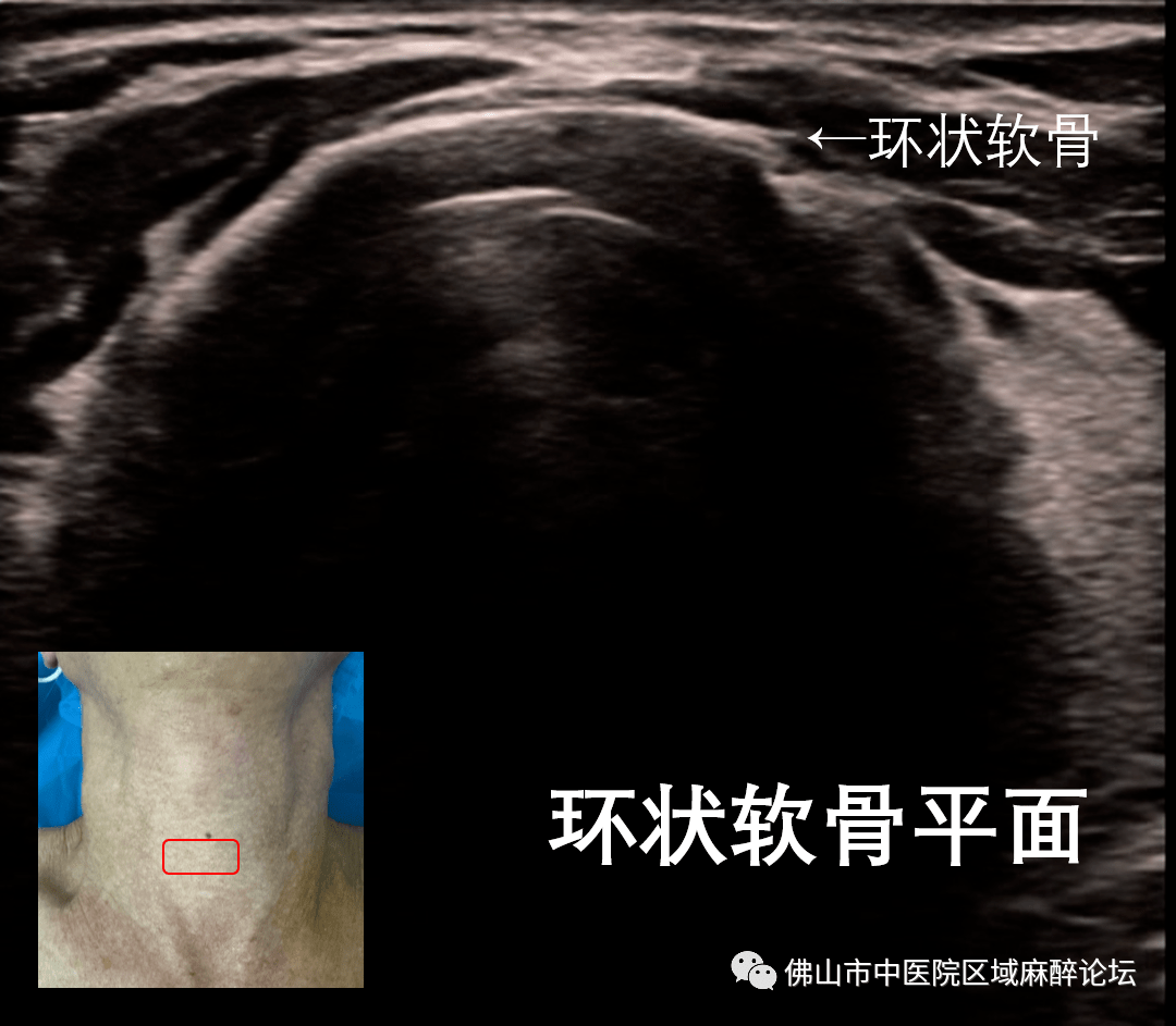 此徵象標誌著環狀軟骨的出現.